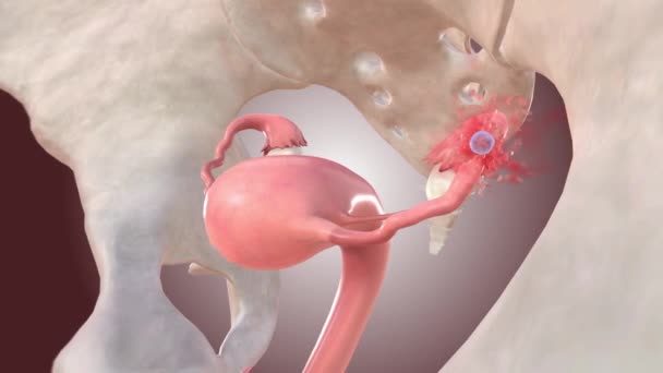 Az ektopikus terhesség embriója csőrepedést okoz - Felvétel, videó