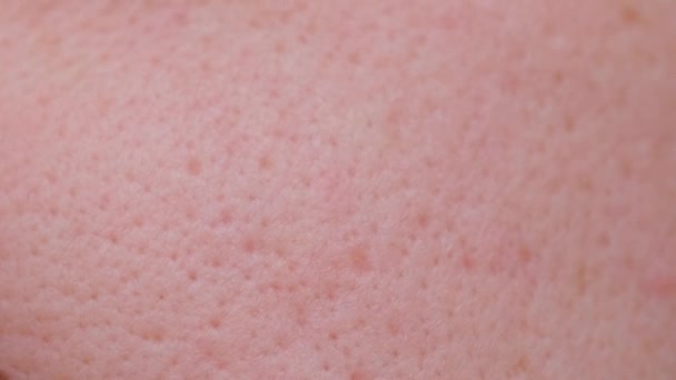 Extremely close-up technology of problem skin of a person with large own pores, acne scars. Macro photo of large pores on oily facial skin. - Filmmaterial, Video