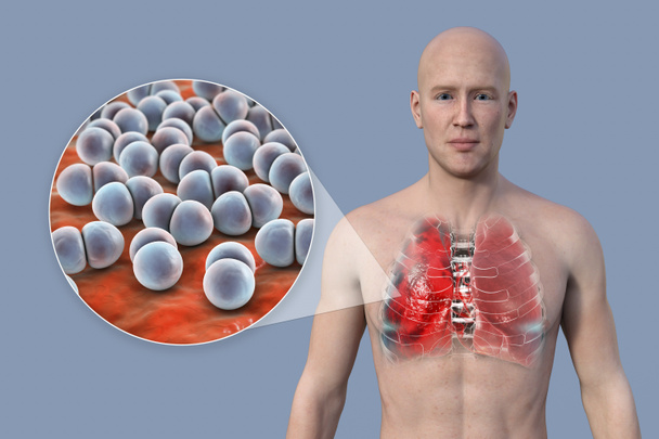 3D фотореалистичная иллюстрация, демонстрирующая верхнюю половину человека с прозрачной кожей, раскрывающая легкие, пораженные пневмонией, и близкий обзор бактерий Streptococcus pneumoniae. - Фото, изображение