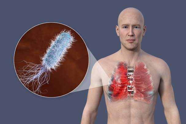 3D-s fotorealisztikus illusztráció, amely bemutatja egy átlátszó bőrű férfi felső felét, feltárja a tüdőgyulladásban szenvedő tüdőt, és közelről szemlélteti a Pseudomonas aeruginosa baktériumokat. - Fotó, kép