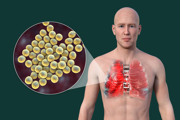 3D-s fotorealisztikus illusztráció, amely bemutatja egy átlátszó bőrű férfi felső felét, feltárja a tüdőgyulladásban szenvedő tüdőt, és közelről szemlélteti a Staphylococcus aureus baktériumokat. - Fotó, kép