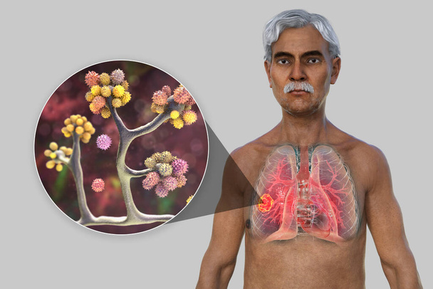 Ilustração 3D fotorealista da metade superior de um paciente sênior do sexo masculino, com pele transparente, revelando lesão de mucormicose pulmonar, com visão de perto dos fungos Cunninghamella bertholletiae. - Foto, Imagem