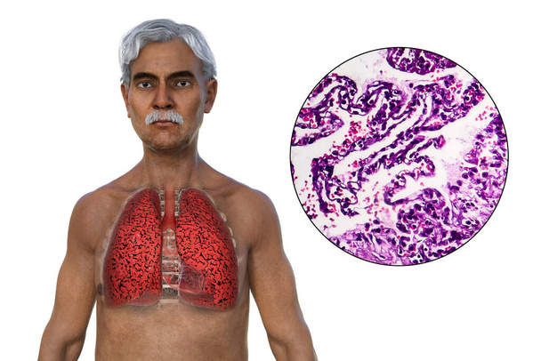 3D-иллюстрация верхней половины человека с прозрачной кожей, показывающая состояние легких курильщика, а также микрографическое изображение легких, пострадавших от курения. - Фото, изображение