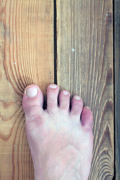 Enfermedad del pie, infecciones cutáneas
 - Foto, imagen