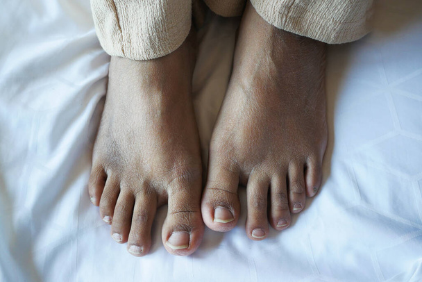close up of women feet with swelling . - Fotó, kép