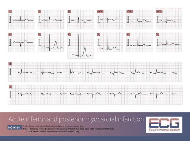 Male, 84 years old, admitted to hospital with chest pain for 1 day. ECG showed acute inferior and posterior MI and possibly right MI. The patient died of ventricular fibrillation the next day. - Photo, Image