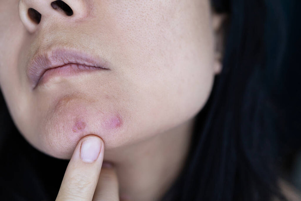 Close-up of woman with acne on her cheek and chin. - Fotografie, Obrázek