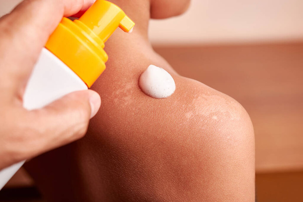 泡は皮膚の損傷を受けた領域に適用されます。肌に日焼けします。ボディスキンケア。過剰な日焼けや皮膚刺激からの保護. - 写真・画像