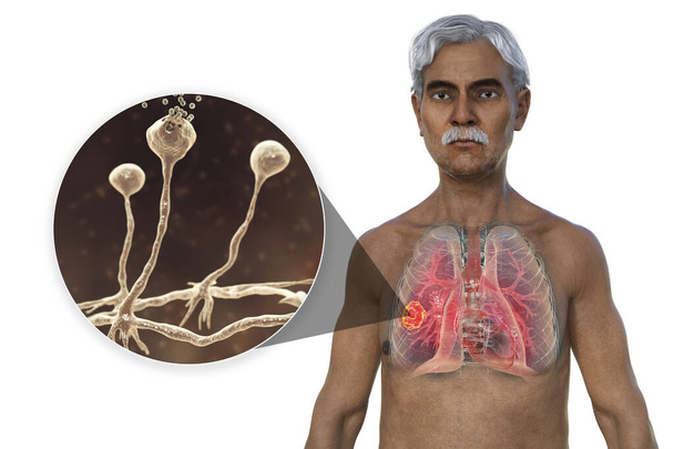 Ilustração 3D fotorealista da metade superior de um paciente sênior do sexo masculino, com pele transparente, revelando lesão de mucormicose pulmonar, com visão de fundo dos fungos Rhizopus. - Foto, Imagem