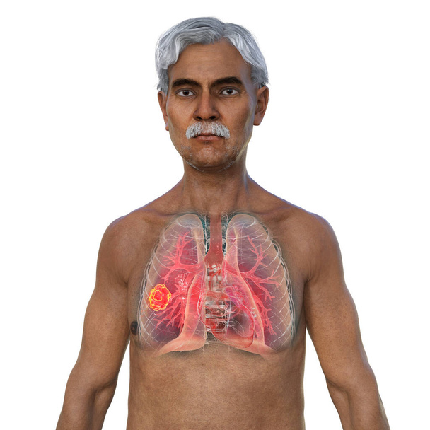 Uma ilustração 3D fotorealista da metade superior de um homem com pele transparente, revelando uma lesão de mucormicose pulmonar. - Foto, Imagem