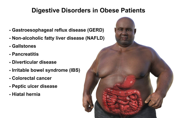 Eine detaillierte medizinische 3D-Illustration eines übergewichtigen Mannes mit transparenter Haut, die das Verdauungssystem enthüllt und die mit Fettleibigkeit verbundenen Verdauungsprobleme hervorhebt. - Foto, Bild