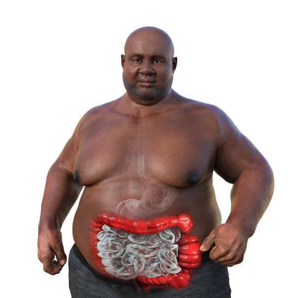 Egy túlsúlyos ember átlátszó bőrrel, bemutatva az emésztőrendszert, és kiemelve a vastagbél görcsök kapcsolódó irritábilis bél szindróma, 3D illusztráció. - Fotó, kép