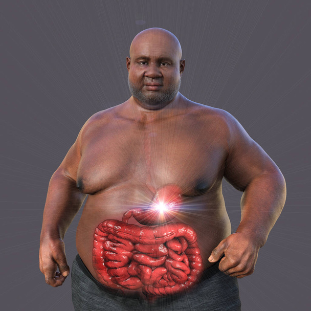 Een gedetailleerde 3D medische illustratie van een man met overgewicht met een transparante huid, die het spijsverteringsstelsel onthult en de aandacht vestigt op de spijsverteringsproblemen in verband met obesitas. - Foto, afbeelding