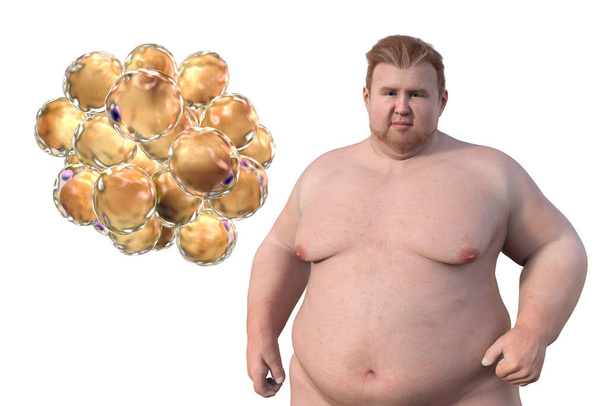 Una ilustración médica en 3D que representa a un hombre con sobrepeso con una visión cercana de los adipocitos, destacando el papel de estas células grasas en la obesidad. - Foto, Imagen