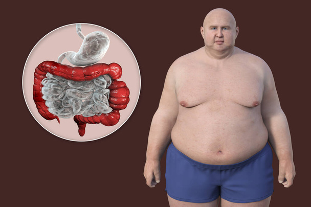 Człowiek z nadwagą, i zbliżenie widok jego układu pokarmowego podkreślając obecność skurcze jelita grubego związane z zespołem jelita drażliwego, Ilustracja 3D. - Zdjęcie, obraz