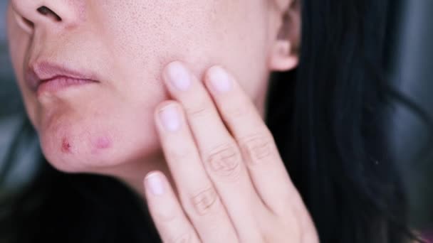 Close up of sad woman touching acne on her face. - Footage, Video