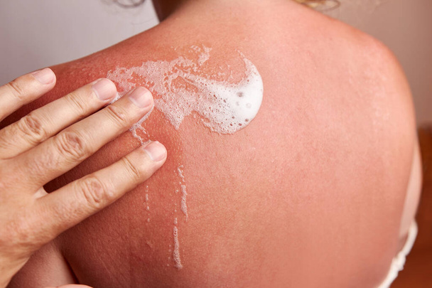 The foam is applied to sun-damaged areas of the skin. Sunburns on the skin. Body skin care. Protection against excessive sunburn and skin irritation. - Photo, image