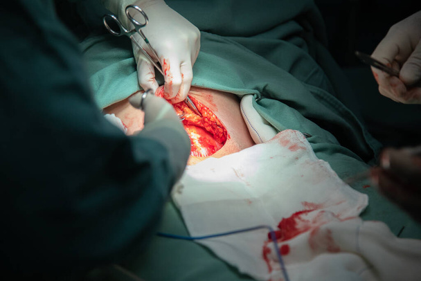 procedimiento de cesárea en el hospital - Foto, Imagen