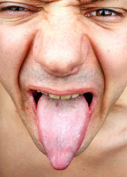 nyelv fertőzés - Fotó, kép