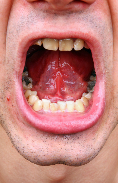 Tartar and tooth decay - Photo, Image