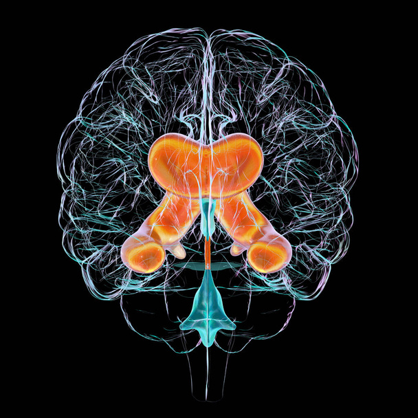 3D tieteellinen kuva kuvaa laajentuneen sivusuunnassa kammiot aivojen (vesipää). - Valokuva, kuva
