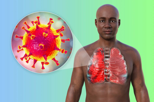 A 3D photorealistic illustration showcasing the upper half part of a man with transparent skin, revealing the lungs affected by Covid-19 pneumonia, and close-up view of SARS-CoV-2 viruses. - Photo, Image