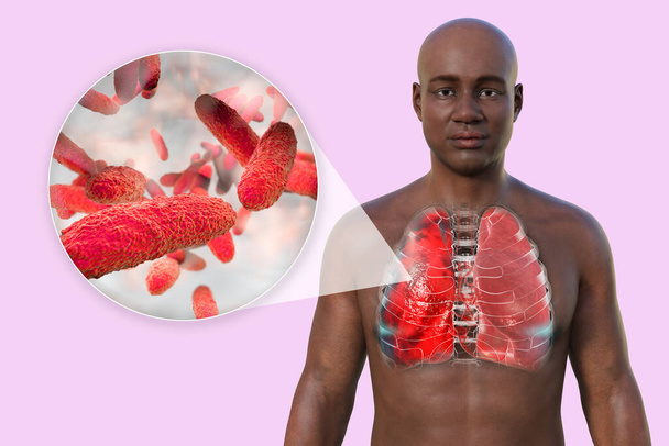 A 3D photorealistic illustration showcasing the upper half part of a man with transparent skin, revealing the lungs affected by pneumonia, and close-up view of Klebsiella pneumoniae bacteria. - Photo, Image