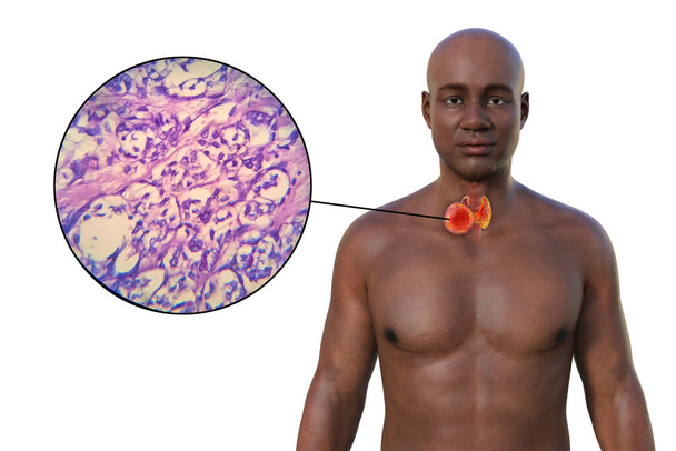Cáncer de tiroides. Ilustración 3D que muestra a un hombre con piel transparente, revelando un tumor en la glándula tiroides junto con un fotomicrograma del cáncer de tiroides. - Foto, imagen