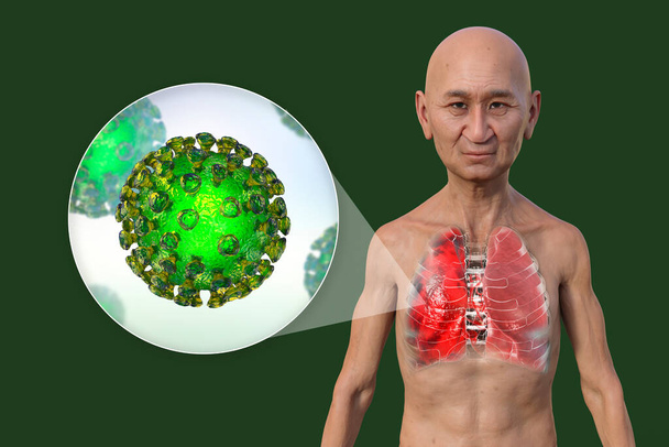 3D-s fotorealisztikus illusztráció, amely bemutatja egy átlátszó bőrű férfi felső felét, feltárja a Covid-19 tüdőgyulladás által érintett tüdőt és a SARS-CoV-2 vírusok közeli képét. - Fotó, kép