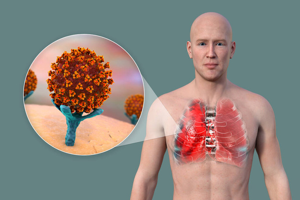 Una ilustración en 3D que muestra la mitad superior de un hombre con piel transparente, revelando los pulmones afectados por la neumonía por Covid-19, y una vista cercana de los receptores celulares de unión al virus SARS-CoV-2. - Foto, Imagen
