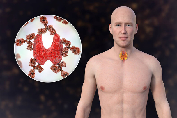 自動免疫甲状腺炎(橋本病)について。 透明な皮膚を持つ男性を示す3Dイラスト,甲状腺を攻撃する抗体のクローズアップビューで甲状腺を明らかに. - 写真・画像