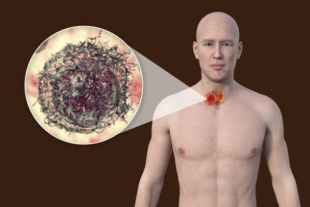 Cáncer de tiroides. Ilustración 3D que muestra a un hombre con piel transparente, revelando un tumor en la glándula tiroides con vista cercana de las células cancerosas. - Foto, imagen