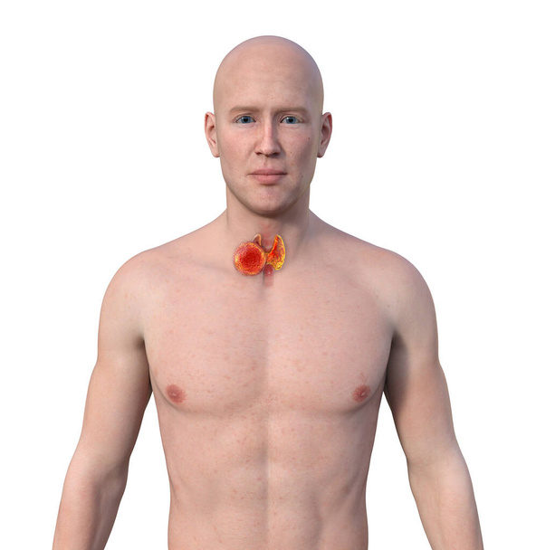 Kilpirauhassyöpä. 3D-kuva, joka esittelee miehen, jolla on läpinäkyvä iho, paljastaen kasvain kilpirauhasessa. - Valokuva, kuva
