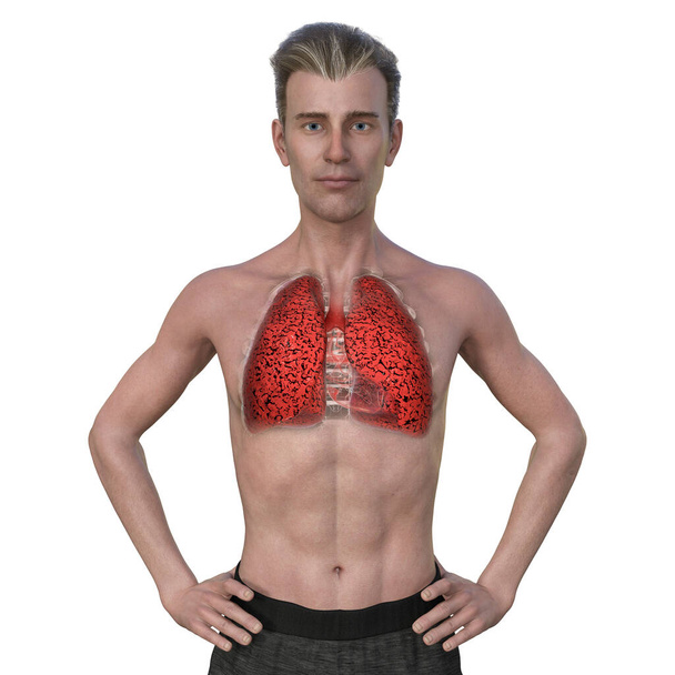Μια τρισδιάστατη φωτορεαλιστική απεικόνιση του άνω ημισφαιρίου ενός άνδρα με διάφανο δέρμα, αποκαλύπτοντας την κατάσταση των πνευμόνων του καπνιστή. - Φωτογραφία, εικόνα
