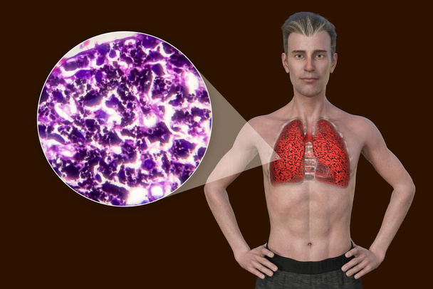 Een 3D-illustratie van de bovenste helft van een man met een transparante huid, onthullen de toestand van de longen van roker, samen met een micrograaf beeld van de longen beïnvloed door roken. - Foto, afbeelding