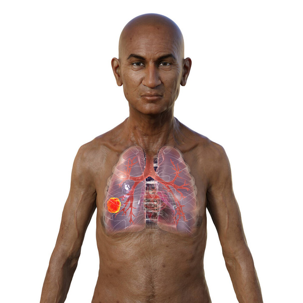 A 3D photorealistic illustration of the upper half part of a man with transparent skin, revealing the presence of lung cancer. - Photo, Image