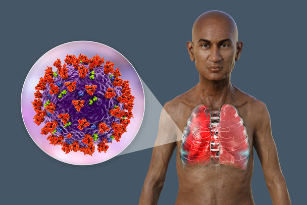 Fotorealistyczna ilustracja 3D przedstawiająca górną połowę człowieka z przezroczystą skórą, ujawniająca płuca dotknięte zapaleniem płuc typu Covid-19 oraz widok z bliska wirusów SARS-CoV-2. - Zdjęcie, obraz