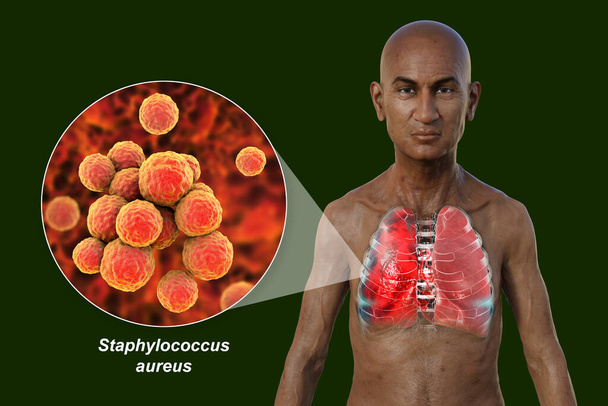 3D-s fotorealisztikus illusztráció, amely bemutatja egy átlátszó bőrű férfi felső felét, feltárja a tüdőgyulladásban szenvedő tüdőt, és közelről szemlélteti a Staphylococcus aureus baktériumokat. - Fotó, kép