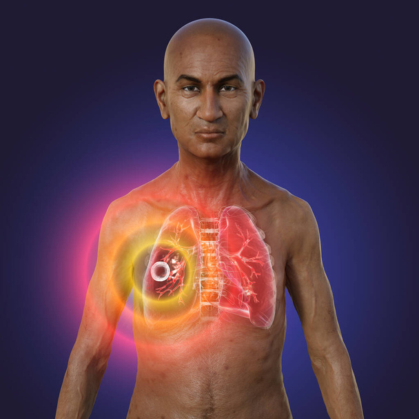 A 3D photorealistic illustration of the upper half of a man with transparent skin, showcasing the lungs affected by cavernous tuberculosis. - Photo, Image