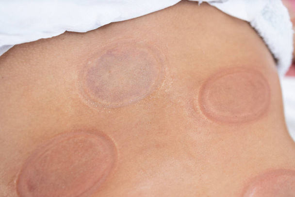 Close-up zicht van hijama cupping merken op het lichaam na de behandeling. - Foto, afbeelding