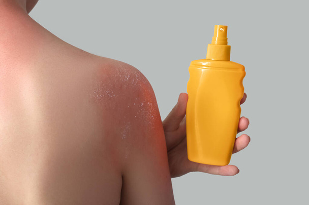 Allergic young woman with sunburned skin and cream on grey background, back view - Фото, изображение