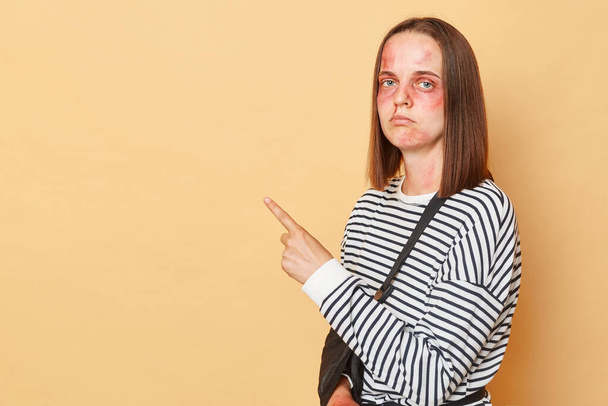 Despair woman with bruises and injuries wearing striped shirt standing isolated over beige background pointing at copy space advertising rehabilitation center for victims of violence - Foto, Bild