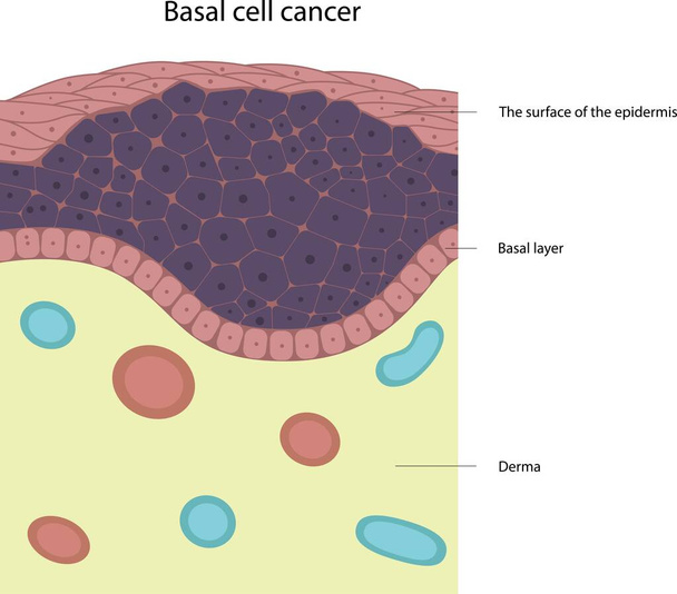 Basal cell cancer. Skin disease. Tumor cells. Skin cancer. - Vector, Image