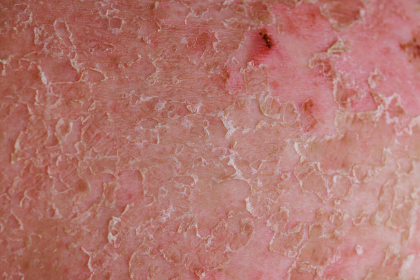 Psoriatický ekzém je kožní onemocnění, které spadá do oblasti dermatologie. - Fotografie, Obrázek