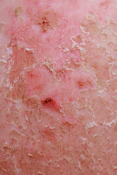 Specjaliści dermatolodzy często spotykają przypadki wyprysku łuszczycowego w swojej praktyce. - Zdjęcie, obraz