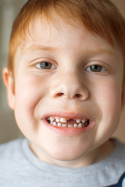 Retrato de un niño de seis años pelirrojo sin un diente delantero. La sonrisa de un niño sin un diente superior - Foto, imagen