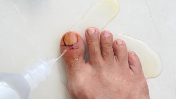 очистити рану На ногах чоловіка від нещасного випадку вдома ізольовано на білому тлі - Кадри, відео