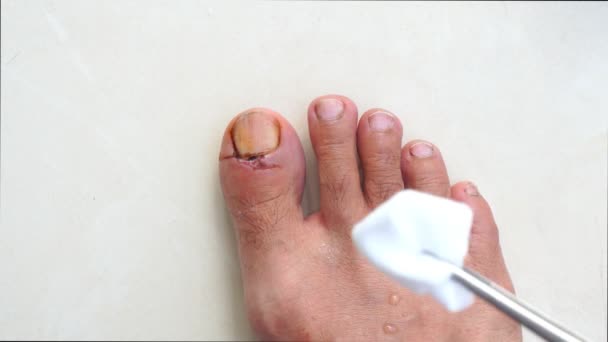 Wunde reinigen An den Füßen eines Mannes nach einem Unfall zu Hause isoliert auf weißem Hintergrund - Filmmaterial, Video