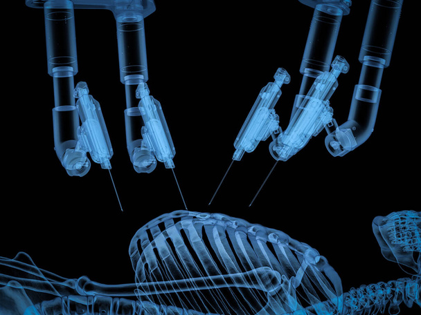 3D vykreslování x-ray robotické asistované chirurgie stroj s pacientem izolované na černé - Fotografie, Obrázek