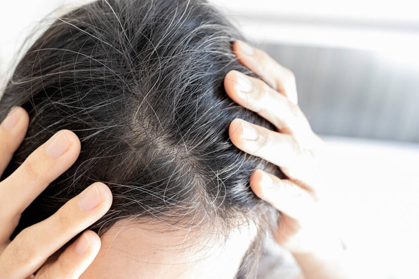 Преждевременная седые волосы проблема, подчеркнул азиатской молодой женщины с выпадением волос, щитовидной железы или аутоиммунных расстройств, алопеция области, недостаток витаминов, обеспокоены седеющие волосы, здравоохранение, медицинская концепция - Фото, изображение
